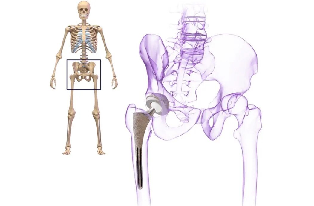 Имплант бедренной кости. Эндопротез кости бедра. Тазобедренный протез. Имплант тазобедренного сустава. Скелет человека бедро