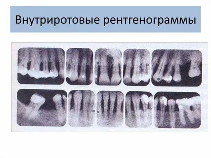 Внутриротовая рентгенография