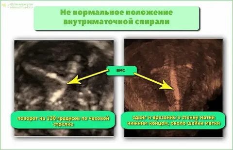 Выделения при спирали мирена