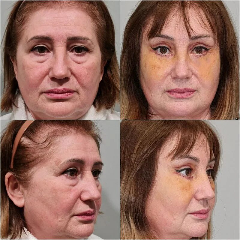 Темпоропластика височный лифтинг. Подтяжка верхнего. Круговая подтяжка блефаропластика. Подтяжка верхнего. Блефаропластика трансконъюктивальная (2 века).