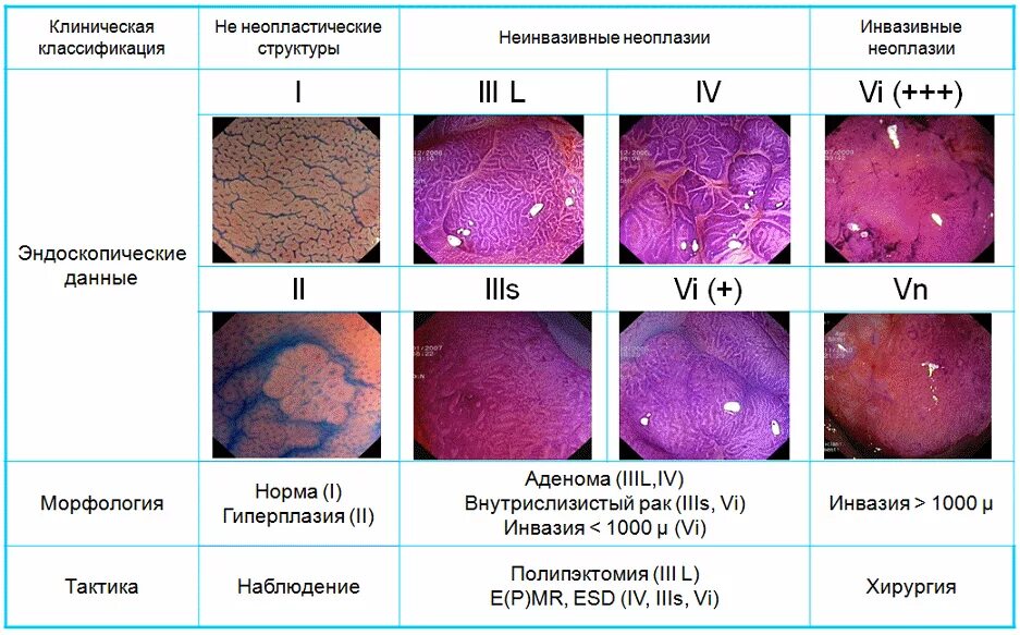 Классификация рельефа поверхности Pit pattern Kudo-Fujii 2010. Kudo классификация полипов. Kudo классификация полипов толстой кишки. Kudo классификация эндоскопическая. Классификации эндоскопия