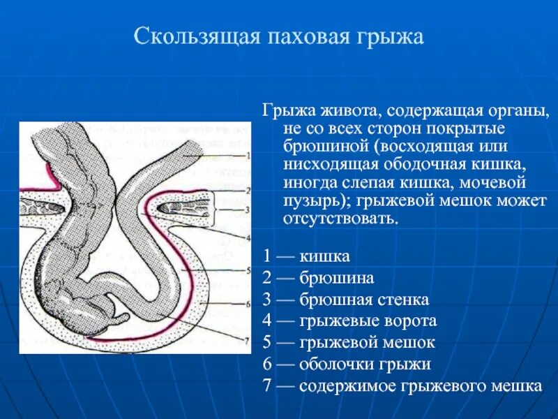 Паховая грыжа у мужчин народные средства. Неотложка ущемленная паховая грыжа. Виды операций паховой грыжи. Паховая грыжа методика операции. Косая паховая грыжа операция.