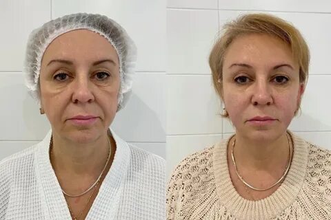 Смас радиесс
