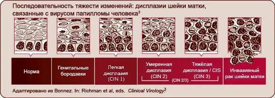 Умеренная дисплазия шейки матки что это. Умеренная дисплазия шейки матки. Дисплазия шейки матки симптомы. Дисплазия шейки матки 1 степени.