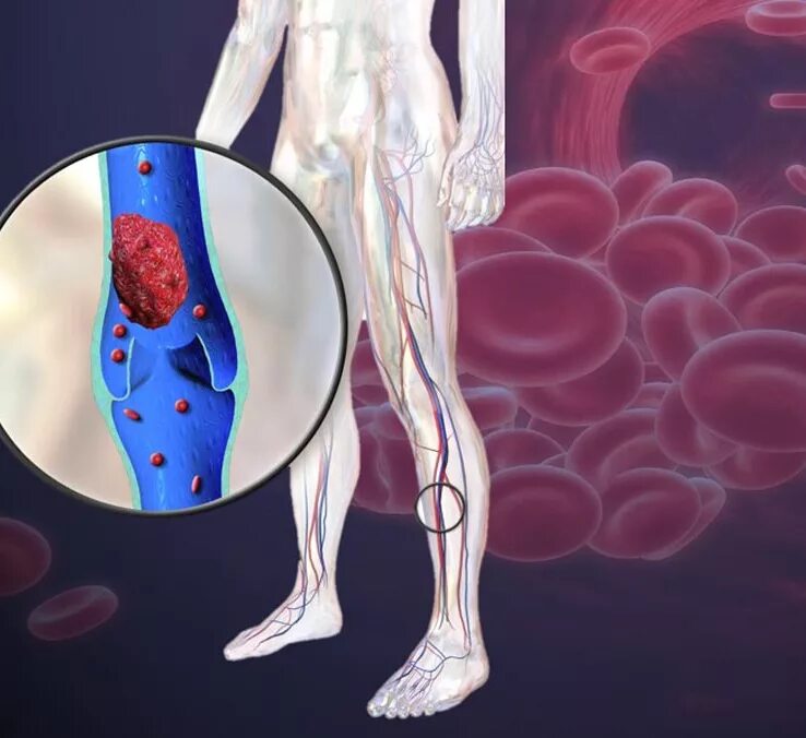 Тромбоз вен патанатомия. Анкилозирующий тромбоз. Венозная тромбоэмболия. Чем отличается тромб