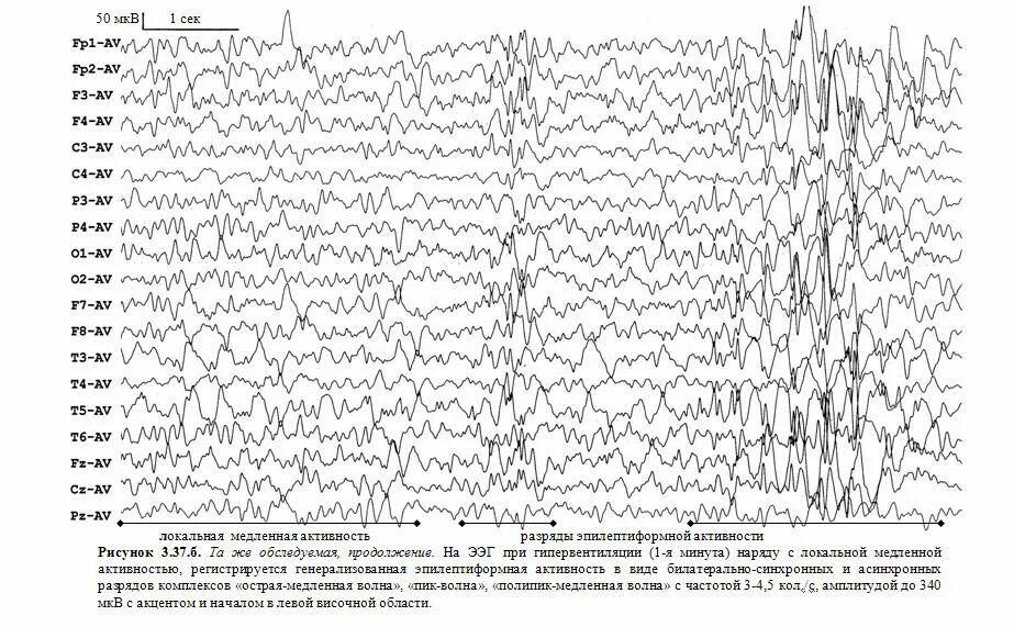 Что значит эпилептиформная активность. Комплекс Спайк медленная волна на ЭЭГ. Пик волна на ЭЭГ. ЭЭГ эпилепсия пик-волна. Эпилептиформная активность на ЭЭГ.