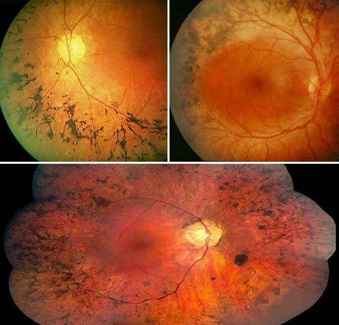 Периферические ретинальные дегенерации. Пигментный ретинит сетчатки. Пигментная абиотрофия сетчатки. Тапеторетинальная абиотрофия сетчатки глазное дно. Белоточечный пигментный ретинит.