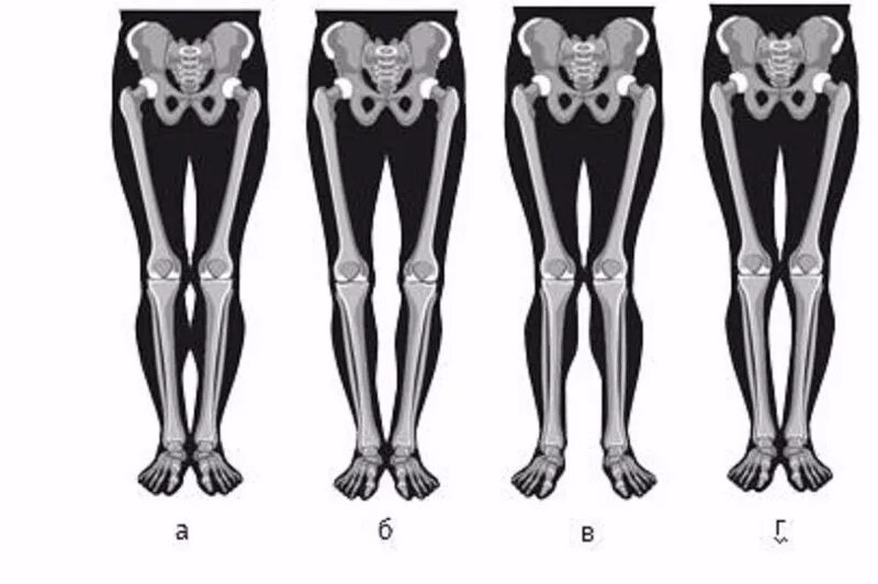 Какие должны быть ноги. Кривые ноги ложная кривизна. Ложное искривление ног. Идеальная форма ног. О образная кривизна ног.