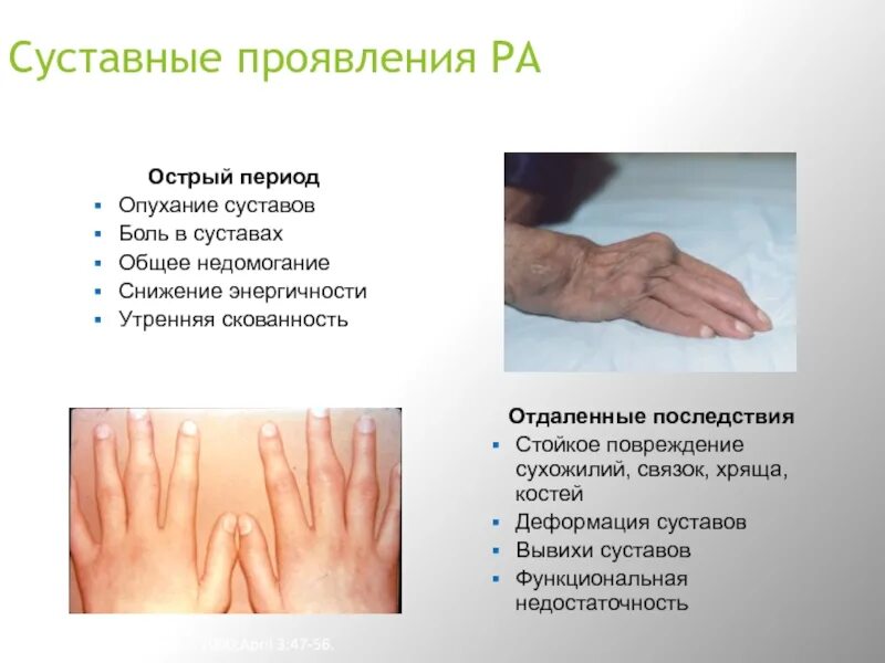 Утренняя скованность суставов. Скованность при ревматоидном артрите. Остеоартрит суставов кистей рук. Скованность в кисти по утрам. Скованность в кисти по утрам.
