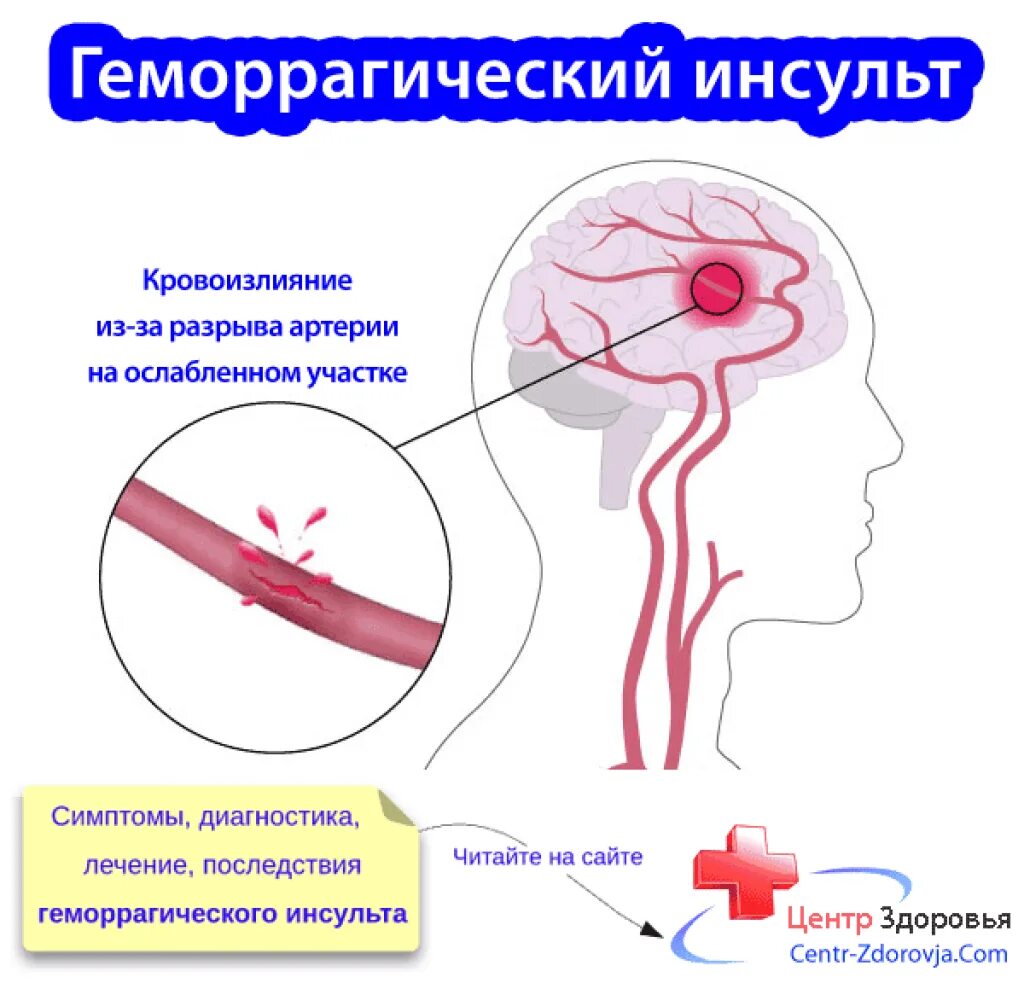 Геморрагический инсульт симптомы симптомы. Геморрагический инсул т. Ґоморрогический инсульт. Был геморрагический инсульт