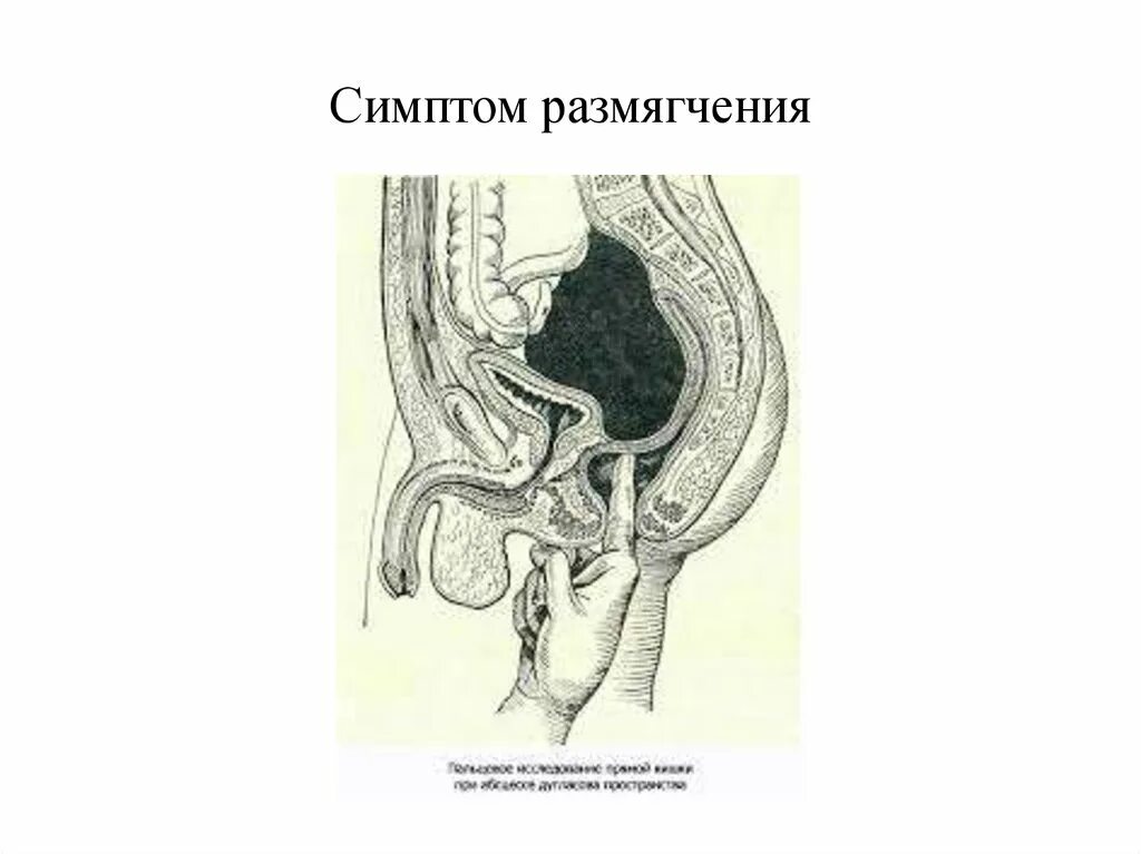 Признак пискачека. Симптом размягчения костей черепа. Размягчение перешейка матки. Размягчение перешейка это.