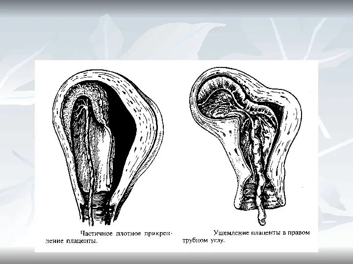 Ущемление отделившейся плаценты (последа) - это. Врастание и прорастание плаценты. Ущемление отделившегося последа. Частичное приращение плаценты. Плацента на рубце матки