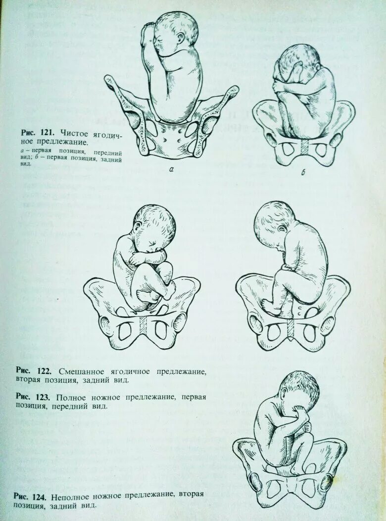 Предлежание 1 позиция. Ягодичное предлежание 2 позиция передний вид. Тазовое предлежание первая позиция передний вид. Продольное тазовое предлежание 1 позиция передний вид. Тазовое предлежание 2 позиция.