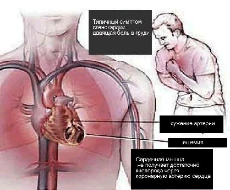 Боли при ишемии. Стенокардия это проявление. Болит сердце.