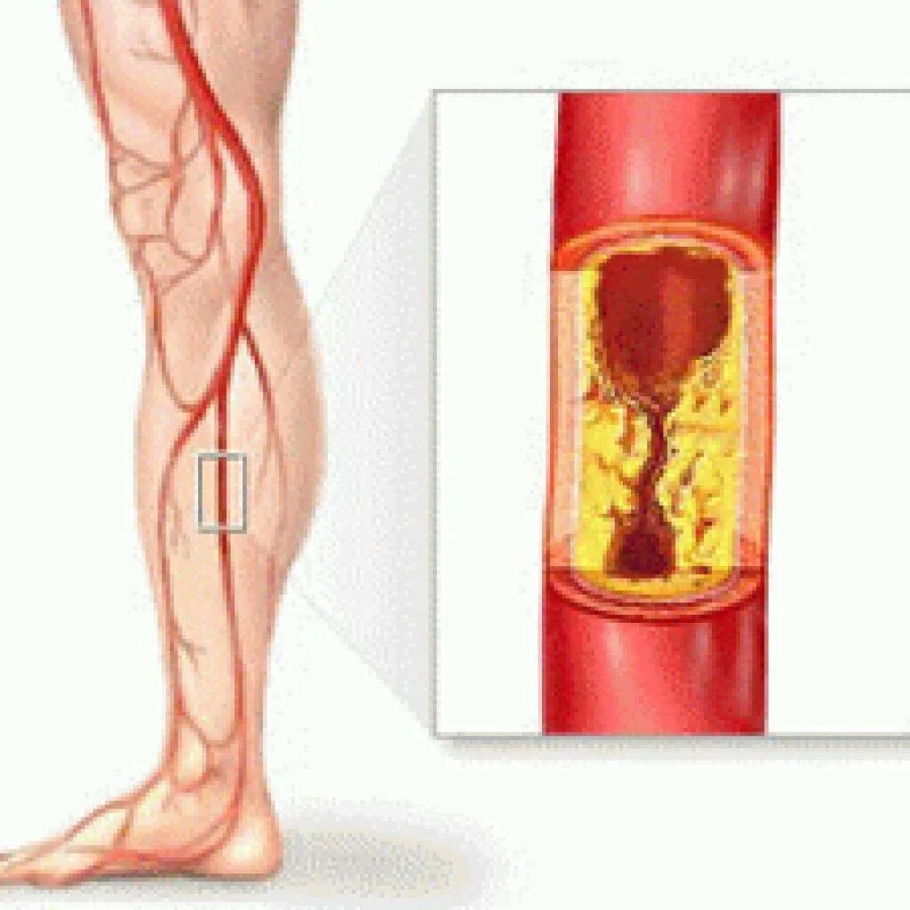 Облитерирующий атеросклероз сосудов нижних. Облитерирующий атеросклероз вен нижних конечностей. Облитерирующий атеросклероз ног. Артериосклероз Менкеберга. Тромб в артерии симптомы