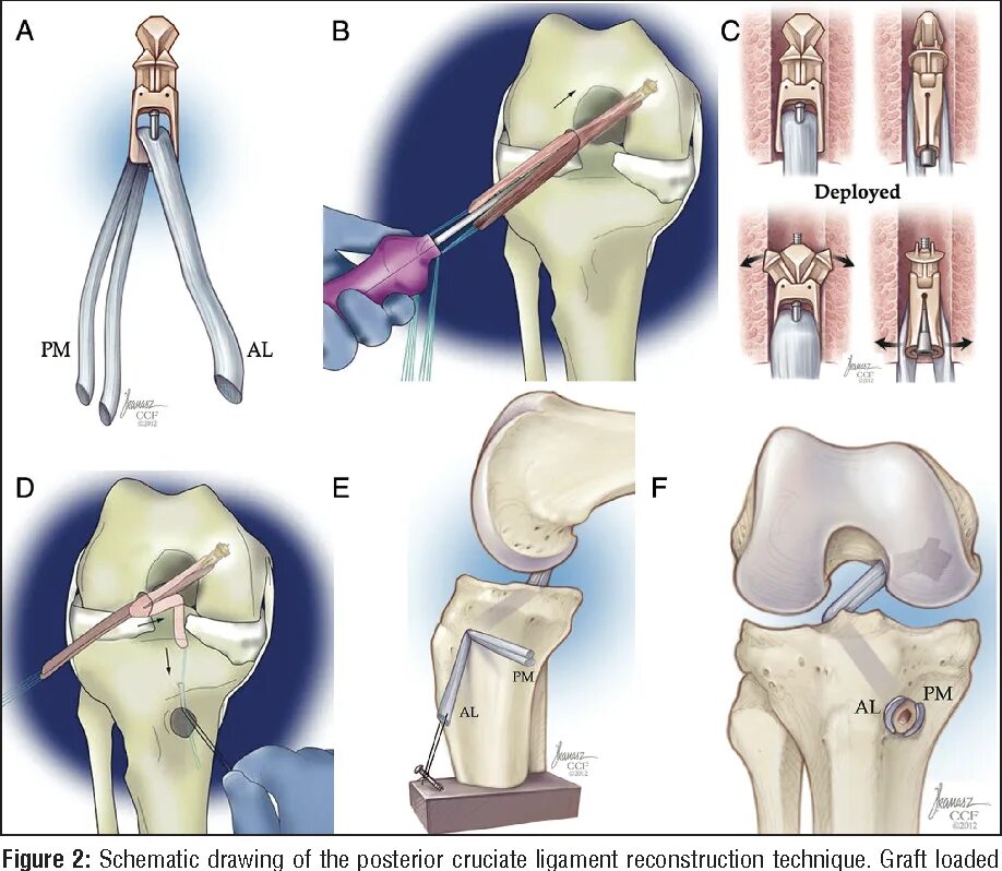 Передняя крестообразная связка после операции. RIGIDFIX femoral St Cross Pin Kit 3.3mm. Разрыв ПКС коленного сустава. Имплант RIGIDFIX femoral St Cross Pin Kit.