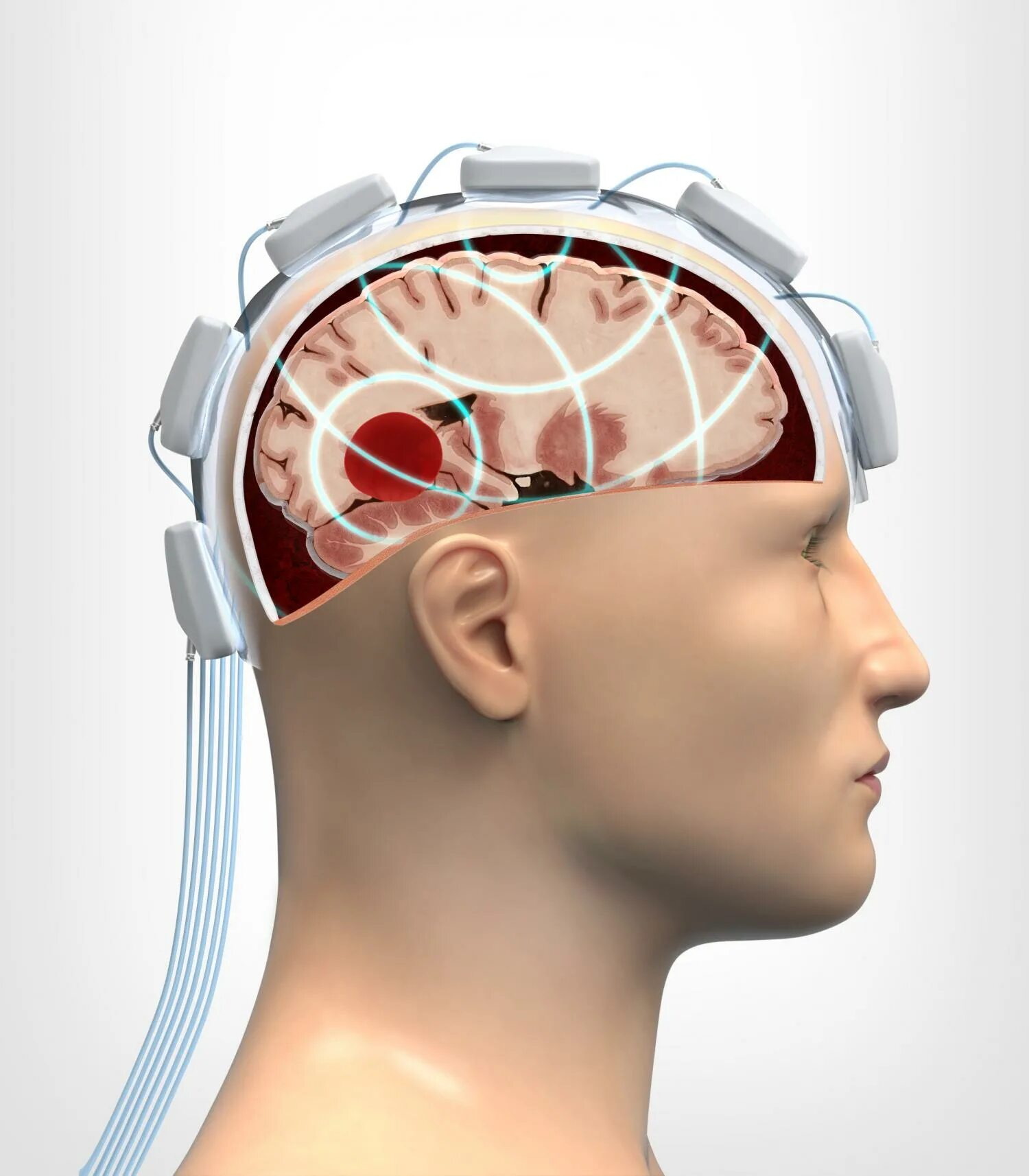 Traumatic brain. Внутричерепная травма головы. Закрытые черепно мозговые травмы.