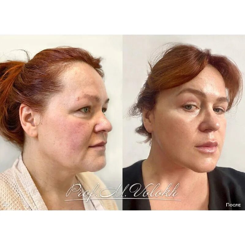 пациентка 38 лет. смас лифтинг второй подбородок. второй подбородок фейслифтинг. эндоскопический лобно-височный лифтинг головач. смас лифтинг результат.