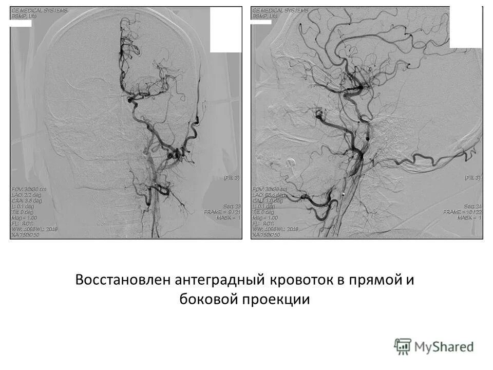 кровоток антеградный в позвоночной артерии что это. антеградное направление кровотока в позвоночной. кровоток антеградный в позвоночной артерии что это. спектральная допплерография схема. допплерография сосудов нижних конечностей.