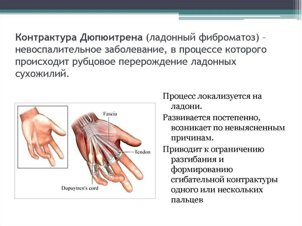 Контрактуру Дюпюитрена (укорочение сухожилий ладоней).. Ладонный апоневроз контрактура Дюпюитрена. Ладонный фиброматоз (контрактура Дюпюитрена). Заболевание кисти рук Дюпюитрена