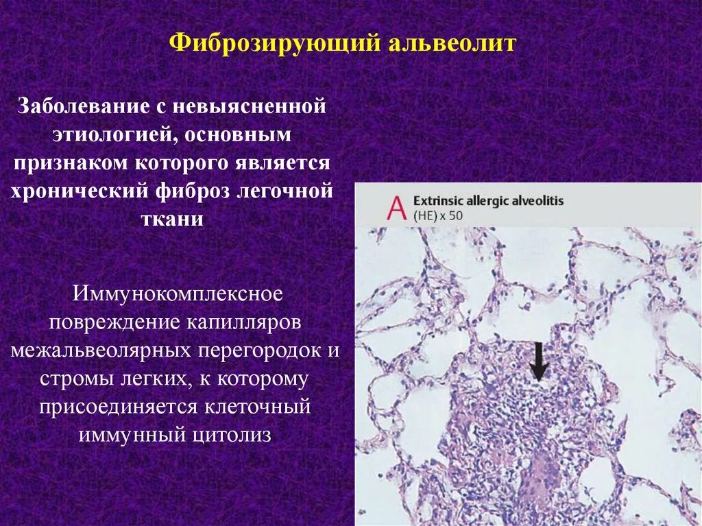 Аллергический альвеолит патогенез. Хронический экзогенный аллергический альвеолит. Идиопатический фиброзирующий альвеолит. Хронический фиброзирующий альвеолит.