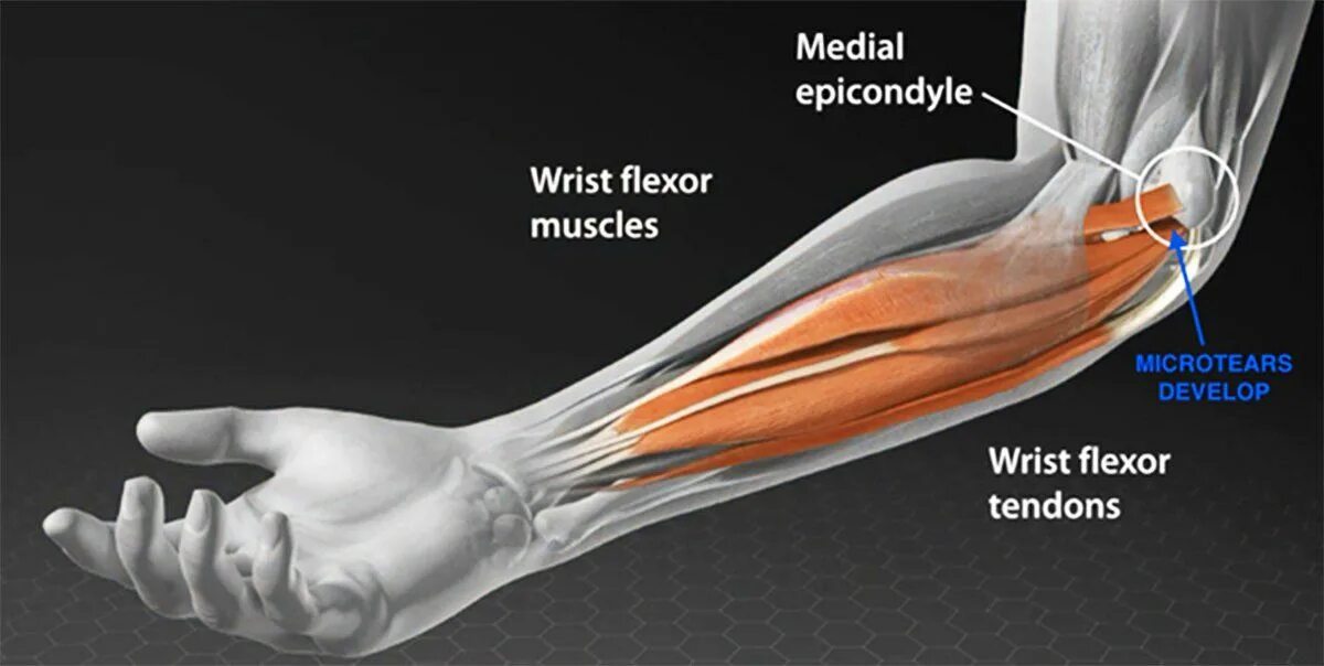 Локтевой сустав мышцы и сухожилия. Медиальный эпикондилит сухожилия. Сухожилия сгибателей локтевого сустава. Эпикондилит локтевого сустава анатомия. Медиальный эпикондилит локтевого.