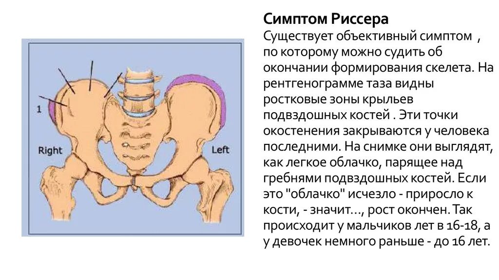 Костный мозг подвздошной кости. Зоны риссера. Тест риссера. Признак риссера при сколиозе. Зоны риссера сколиоз.