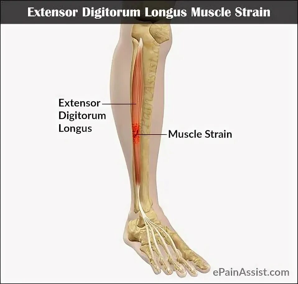 Extensor digitorum longus. Flexor digitorum longus (muscle). m extensor digitorum longus. m flexor digitorum longus голень. musculus extensor digitorum longus pedis.
