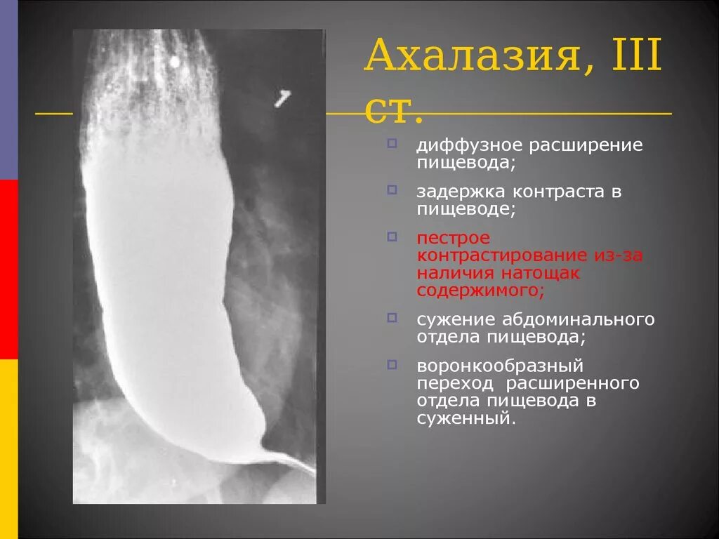 Ахалазия кардии пищевода что это. Ахалазия кардии патогенез. Кардиального сфинктера. Ахалазия пищевода фгдс. Ахалазия пищевода 4 степени.
