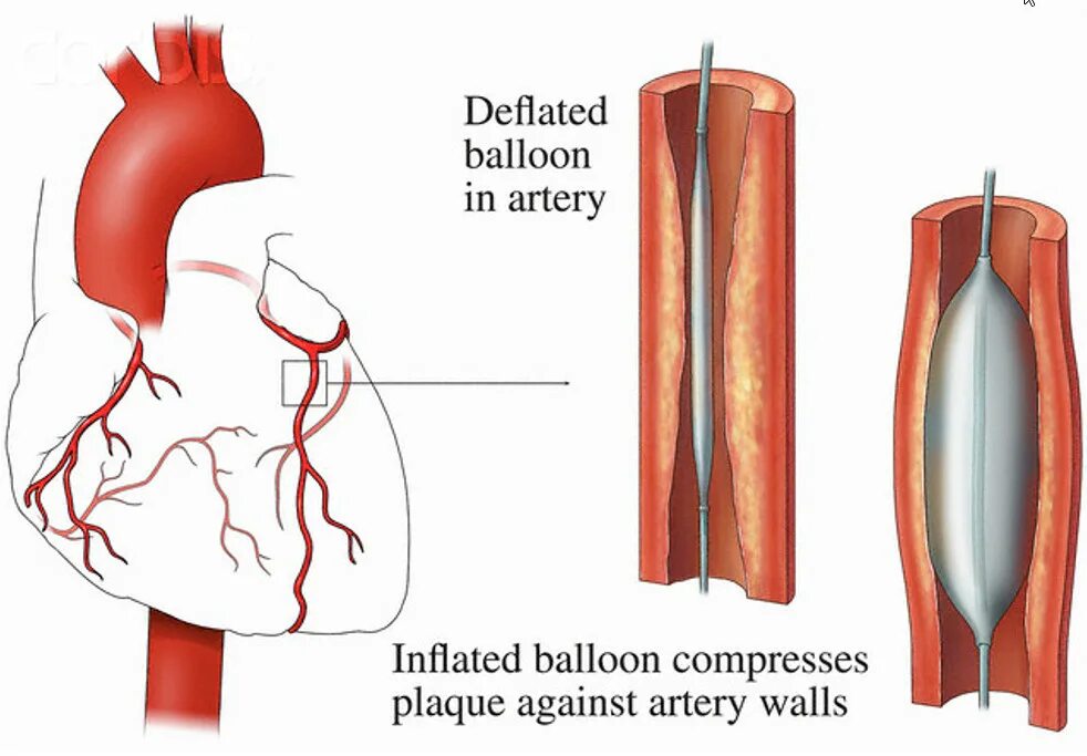 ТРАНСЛЮМИНАЛЬНАЯ ангиопластика коронарных артерий. Баллонная ангиопластика и стентирование. Баллонная ангиопластика сосудов сердца. Эндоваскулярное стентирование. Расширяет коронарные сосуды