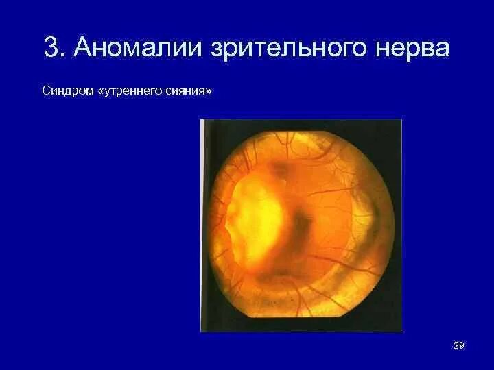 Колобома зрительного нерва. Аномалии развития диска зрительного нерва. Врожденные аномалии зрительного нерва. Врожденные пороки развития зрительного нерва.