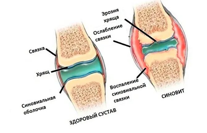 Жидкость в полости коленного сустава на мрт. Синовит синовиальная оболочка. Синовит связки коленного сустава. Что такое синовит коленного коленного сустава. Артрит синовит коленного сустава.