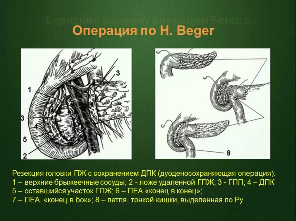 Резекция поджелудочной железы операция. Резекция головки поджелудочной железы. Субтотальная резекция поджелудочной железы. Операция Бегера на поджелудочной железе. Панкреатит операцию делают