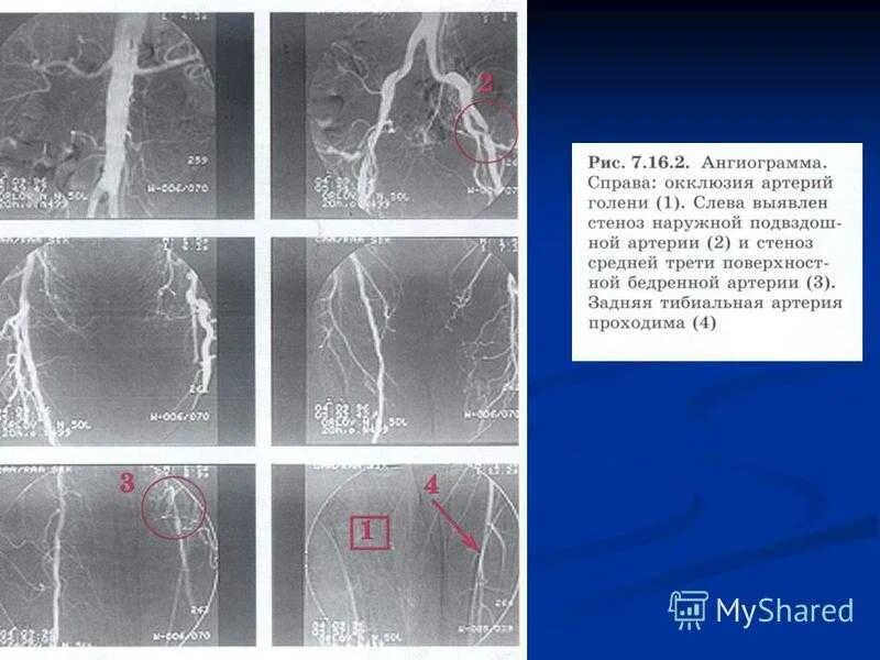 Процент стеноза сосудов. Окклюзия бедренной артерии. Ангиография бедренной артерии. Окклюзии артерии нижних конечностей кт. Стеноз бедренной артерии.