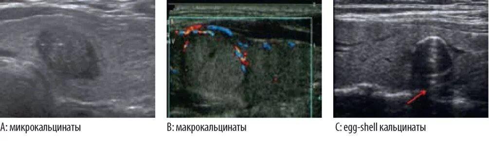 Кальцинат в правой доле. Кальцинат щитовидной железы УЗИ. Узел щитовидной железы с микрокальцинатами. Кальцинированный узел щитовидной железы УЗИ. УЗИ щитовидной железы микрокальцинаты.
