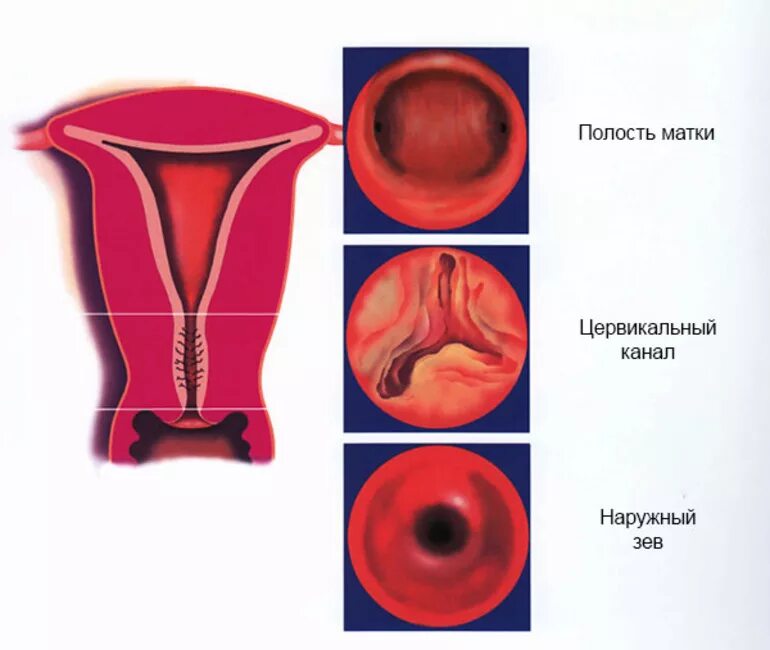 Шейка матки и цервикальный канал. Цервикальный канал и маточный зев. Цервикальный канал при беременности. Цервикальный канал шейки матки что это такое у женщин. Цервикальный канал размеры