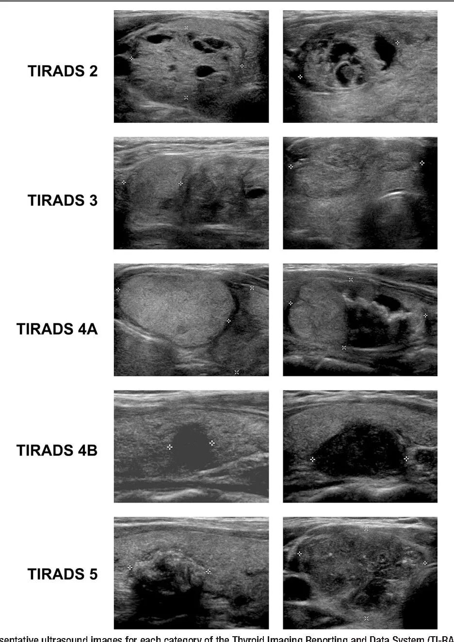 Щитовидная железа УЗИ ti-rads. Классификация Tirads щитовидная железа УЗИ. Tirads4 щитовидной железы Tirads 4. УЗИ щитовидной железы Tirads.