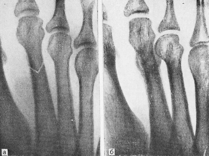 5 фаланга стопы. Перелом Дойчлендера 2 плюсневой кости. Маршевый перелом Дойчлендера. Маршевый перелом плюсневой кости стопы. Маршевый перелом 2 плюсневой кости.