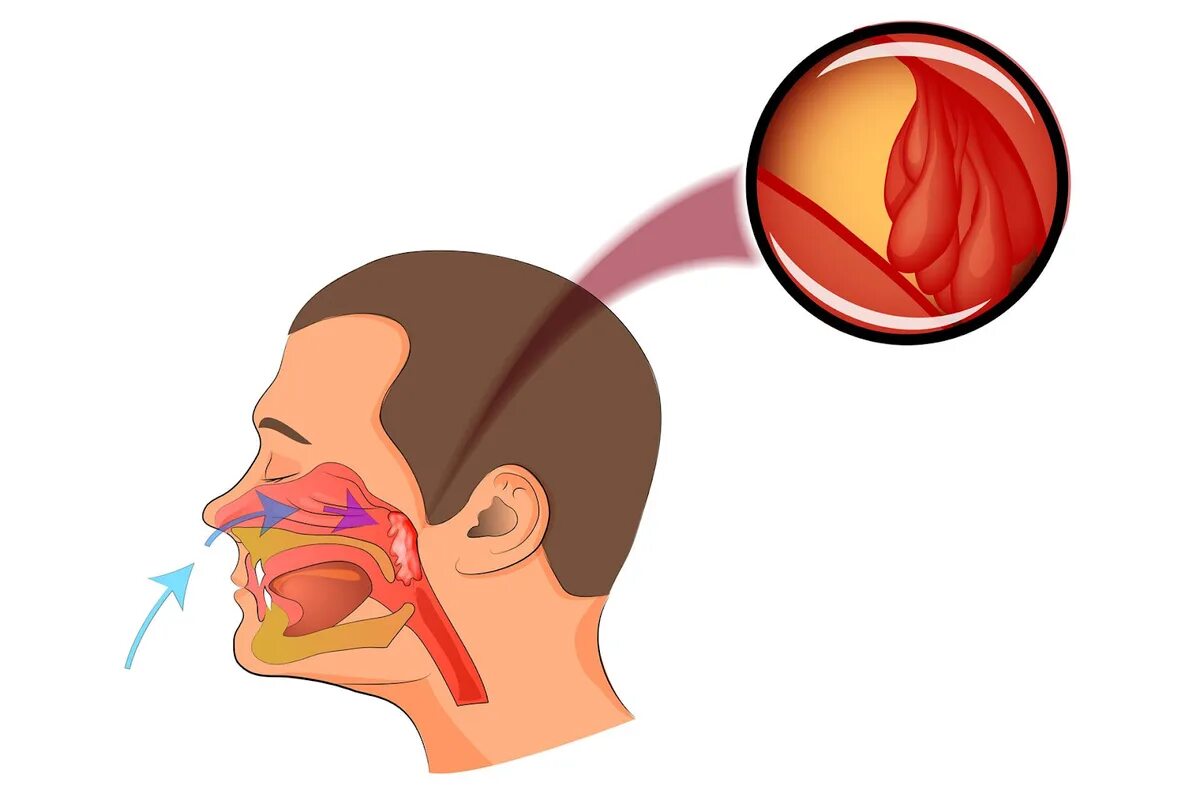 Болит носоглотка что делать. Носоглотка воспаление аденоиды. Носоглоточные аденоиды аденоиды. Анатомия ЛОР органов аденоиды.