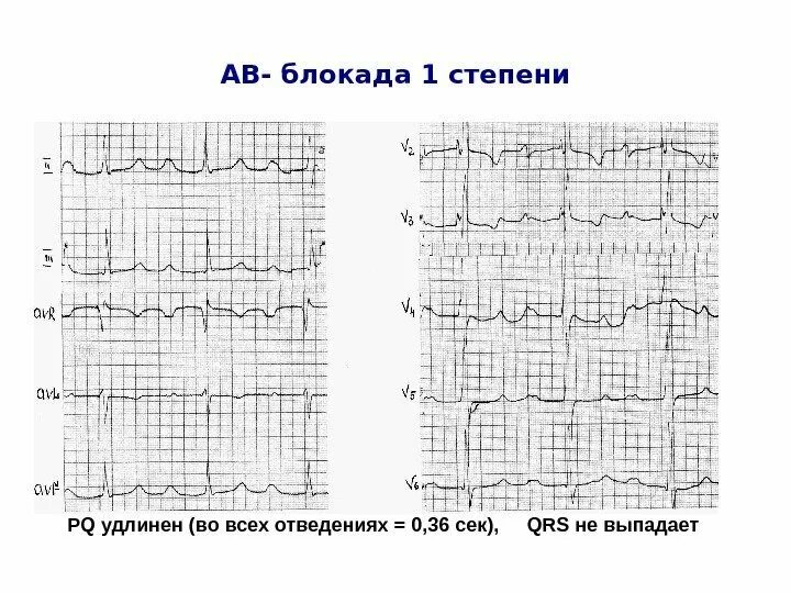 Блокады 2 степени армия. Синоатриальная блокада 2 степени на ЭКГ. Sa блокада 1 степени. Са блокада 2 степени на ЭКГ критерии. Са блокада 2 степени 1 типа.