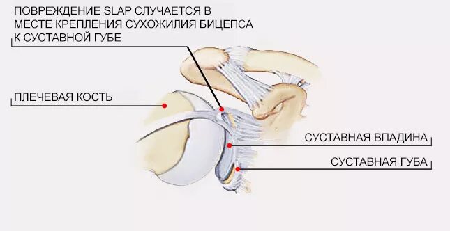 Повреждение губы плечевого сустава