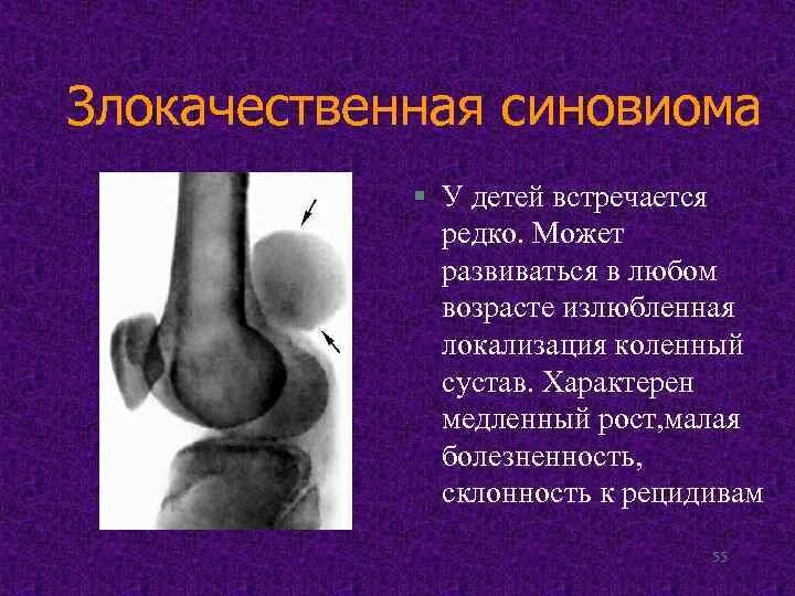 Синовиомы
