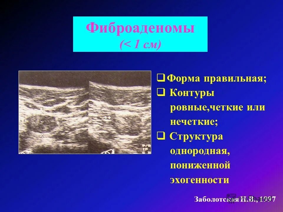 фиброаденома розовая. фиброаденома баня. эксцизия фиброаденомы. фиброаденома баня. дольчатая фиброаденома.