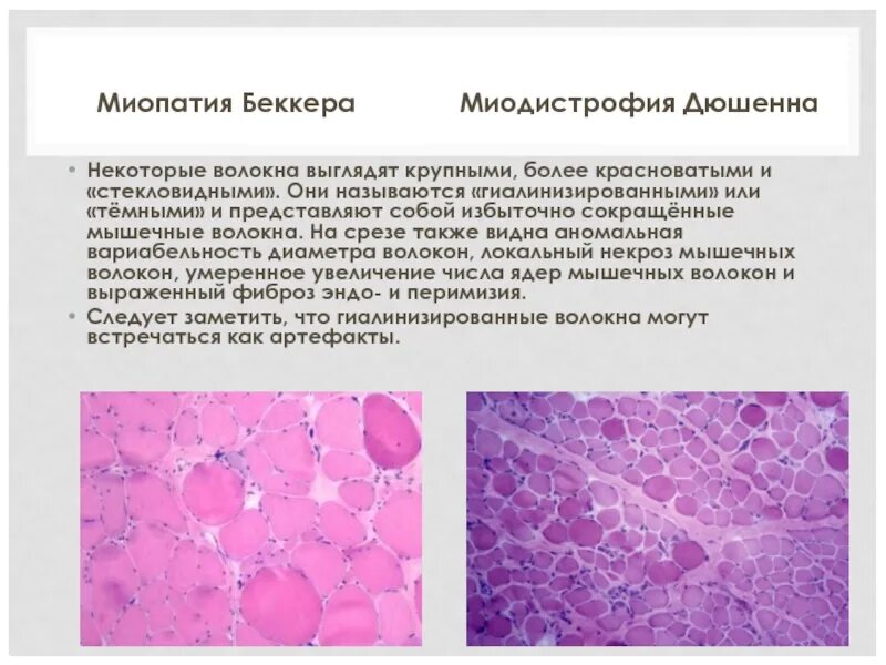 Клиническая миопатия. Этиология миодистрофии Дюшенна. Псевдогипертрофическая миопатия. Дистрофия Дюшенна гистология.