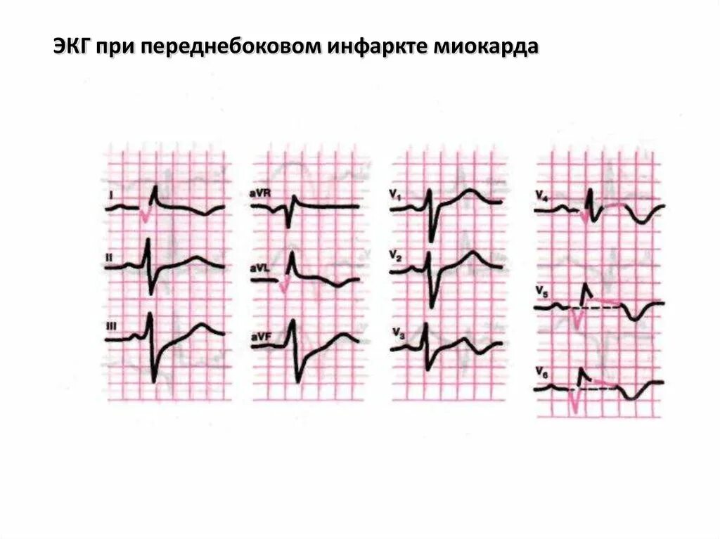 Изменения миокарда предсердий. ЭКГ при переднебоковом инфаркте миокарда. ЭКГ при переднебоковой инфаркт миокарда. Острый инфаркт миокарда переднебоковой стенки на ЭКГ. Переднебоковой инфаркт ЭКГ признаки.