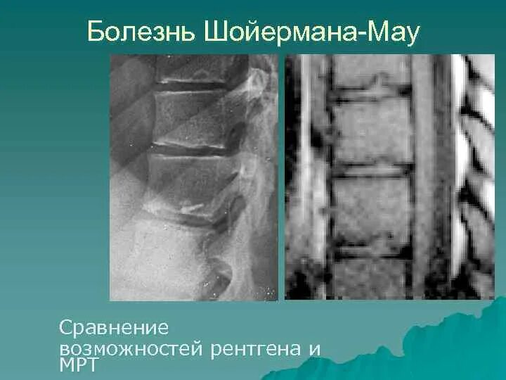 Болезнь шойерман мау что это такое. Позвоночник рентген анатомия. рентген анатомия позвонка. шойерман-мау болезнь рентгенологические. болезнь шойермана мау рентген.