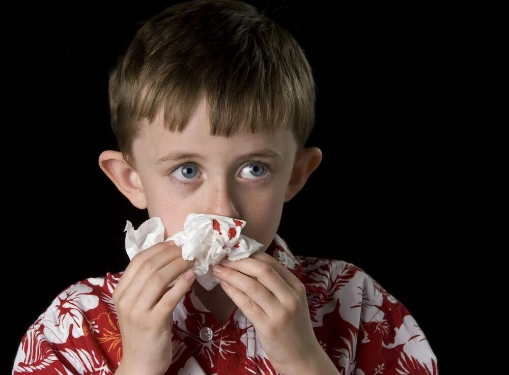 Кровотечение из носа у детей.