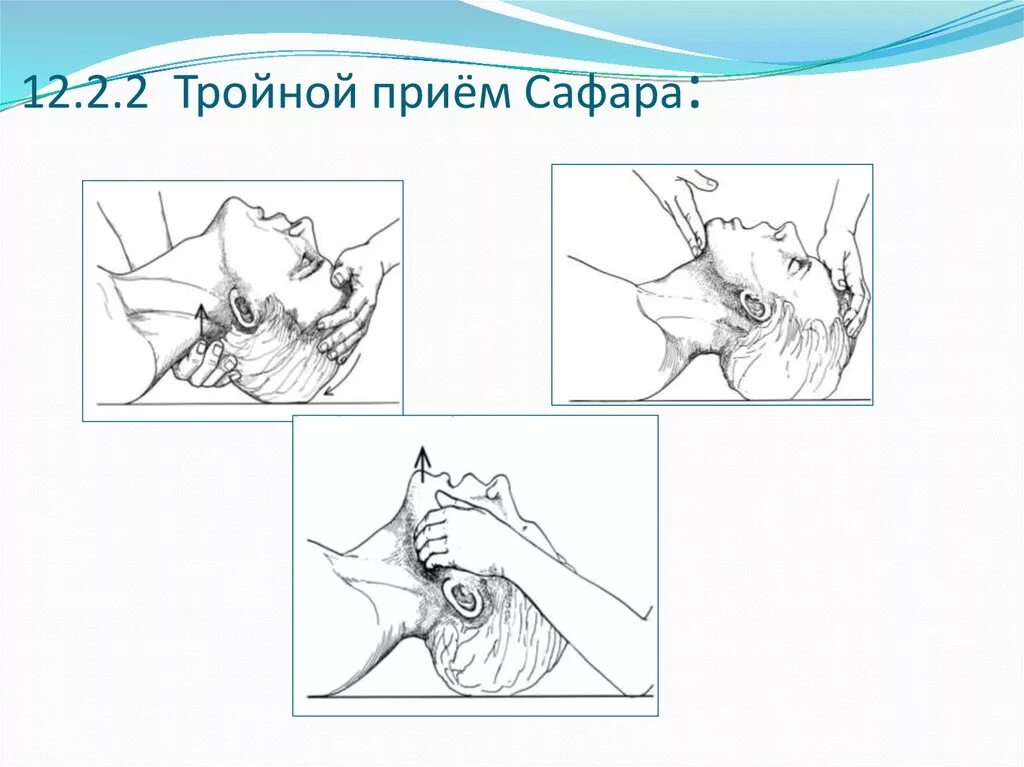Тройной прием алгоритм. Тройной прием Сафара алгоритм. Техника выполнения тройного приема Сафара. Проведение тройного приема Сафара алгоритм. Тройной прием Сафара у детей.