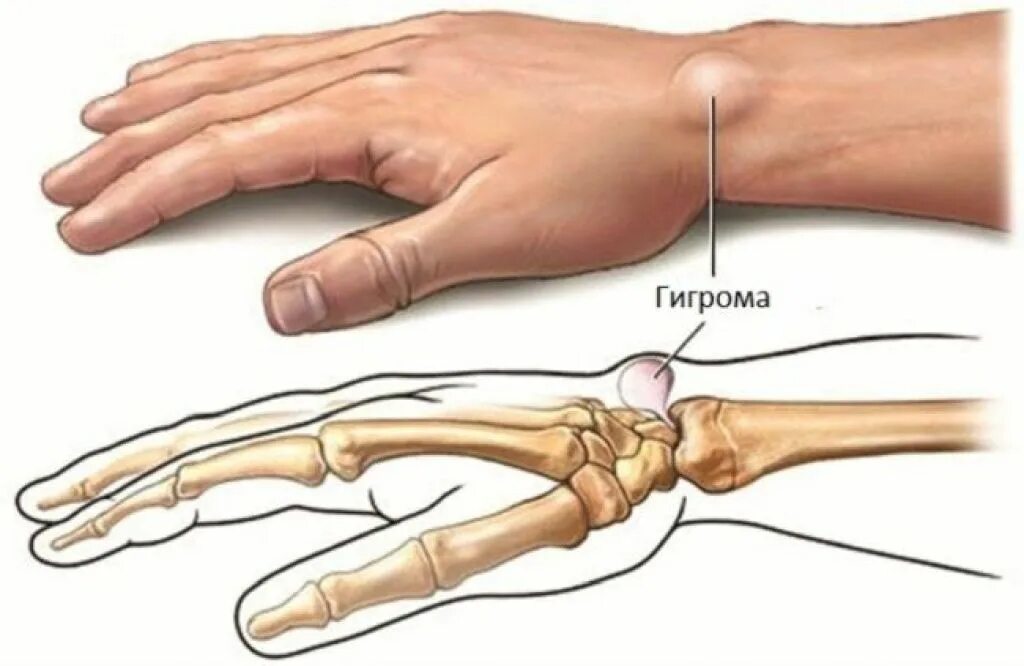 Боль в костях правой руки. Гигрома сухожильный ганглий. Гигрома лучезапястного сустава. Ганглион лучезапястного сустава. Стенозирующий лигаментит.