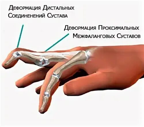 Подкожный разрыв сухожилия пальца. Подкожный разрыв сухожилия пальца